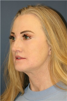 Facelift After Photo by Steve Laverson, MD, FACS; San Diego, CA - Case 39176