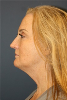 Facelift Before Photo by Steve Laverson, MD, FACS; San Diego, CA - Case 39176