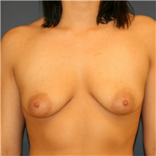 Breast Augmentation Before Photo by Steve Laverson, MD, FACS; Rancho Santa Fe, CA - Case 39178