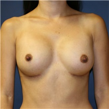 Breast Augmentation After Photo by Steve Laverson, MD, FACS; Rancho Santa Fe, CA - Case 39244