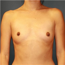 Breast Augmentation Before Photo by Steve Laverson, MD, FACS; Rancho Santa Fe, CA - Case 39244