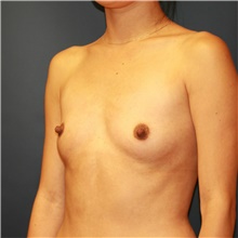 Breast Augmentation Before Photo by Steve Laverson, MD, FACS; Rancho Santa Fe, CA - Case 39244