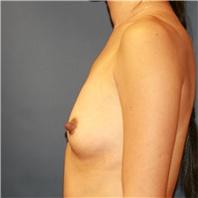 Breast Augmentation Before Photo by Steve Laverson, MD, FACS; Rancho Santa Fe, CA - Case 39244