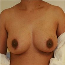 Breast Augmentation After Photo by Steve Laverson, MD, FACS; Rancho Santa Fe, CA - Case 39245