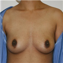 Breast Augmentation Before Photo by Steve Laverson, MD, FACS; Rancho Santa Fe, CA - Case 39245