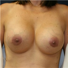 Breast Augmentation After Photo by Steve Laverson, MD, FACS; Rancho Santa Fe, CA - Case 39247