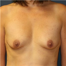 Breast Augmentation Before Photo by Steve Laverson, MD, FACS; Rancho Santa Fe, CA - Case 39247