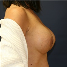 Breast Augmentation After Photo by Steve Laverson, MD, FACS; Rancho Santa Fe, CA - Case 39247