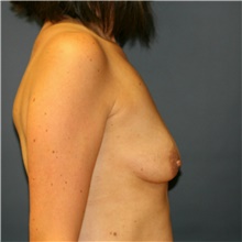 Breast Augmentation Before Photo by Steve Laverson, MD, FACS; Rancho Santa Fe, CA - Case 39247