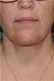 Neck Lift After Photo by Steve Laverson, MD, FACS; Rancho Santa Fe, CA - Case 39256