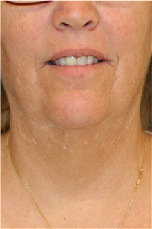 Neck Lift Before Photo by Steve Laverson, MD, FACS; Rancho Santa Fe, CA - Case 39256