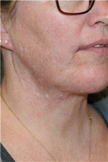 Neck Lift After Photo by Steve Laverson, MD, FACS; Rancho Santa Fe, CA - Case 39256