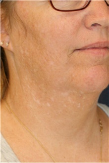 Neck Lift Before Photo by Steve Laverson, MD, FACS; Rancho Santa Fe, CA - Case 39256