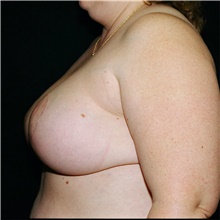 Breast Reduction After Photo by Steve Laverson, MD, FACS; Rancho Santa Fe, CA - Case 39362