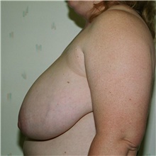 Breast Reduction Before Photo by Steve Laverson, MD, FACS; Rancho Santa Fe, CA - Case 39362