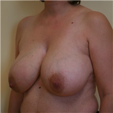 Breast Reduction Before Photo by Steve Laverson, MD, FACS; Rancho Santa Fe, CA - Case 39363