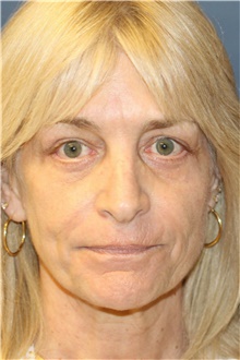 Laser Skin Resurfacing After Photo by Steve Laverson, MD, FACS; San Diego, CA - Case 39549