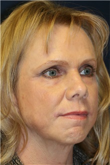 Laser Skin Resurfacing After Photo by Steve Laverson, MD, FACS; San Diego, CA - Case 39641
