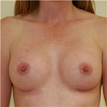 Breast Augmentation After Photo by Steve Laverson, MD, FACS; Rancho Santa Fe, CA - Case 39666