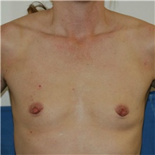 Breast Augmentation Before Photo by Steve Laverson, MD, FACS; Rancho Santa Fe, CA - Case 39666