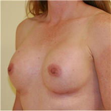 Breast Augmentation After Photo by Steve Laverson, MD, FACS; Rancho Santa Fe, CA - Case 39666