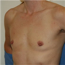 Breast Augmentation Before Photo by Steve Laverson, MD, FACS; Rancho Santa Fe, CA - Case 39666