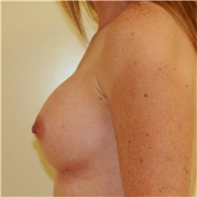 Breast Augmentation After Photo by Steve Laverson, MD, FACS; Rancho Santa Fe, CA - Case 39666