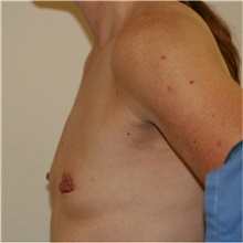 Breast Augmentation Before Photo by Steve Laverson, MD, FACS; Rancho Santa Fe, CA - Case 39666