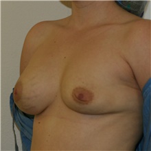 Breast Implant Revision Before Photo by Steve Laverson, MD, FACS; Rancho Santa Fe, CA - Case 39680