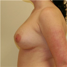 Breast Implant Revision After Photo by Steve Laverson, MD, FACS; Rancho Santa Fe, CA - Case 39680