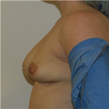 Breast Implant Revision Before Photo by Steve Laverson, MD, FACS; Rancho Santa Fe, CA - Case 39680