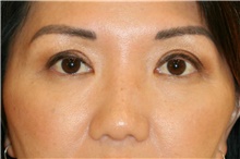 Eyelid Surgery After Photo by Steve Laverson, MD; San Diego, CA - Case 39863