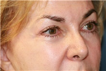 Eyelid Surgery After Photo by Steve Laverson, MD, FACS; Rancho Santa Fe, CA - Case 39997