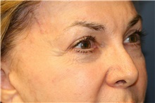 Eyelid Surgery Before Photo by Steve Laverson, MD, FACS; San Diego, CA - Case 39997