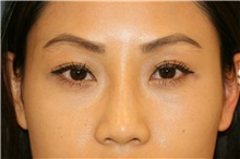 Eyelid Surgery After Photo by Steve Laverson, MD, FACS; San Diego, CA - Case 40002