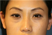 Eyelid Surgery Before Photo by Steve Laverson, MD, FACS; Rancho Santa Fe, CA - Case 40002