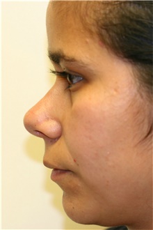 Rhinoplasty After Photo by Steve Laverson, MD, FACS; Rancho Santa Fe, CA - Case 40054