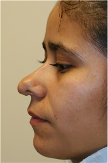 Rhinoplasty Before Photo by Steve Laverson, MD, FACS; Rancho Santa Fe, CA - Case 40054