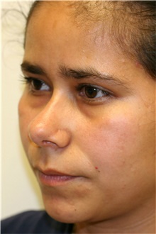 Rhinoplasty After Photo by Steve Laverson, MD, FACS; Rancho Santa Fe, CA - Case 40054