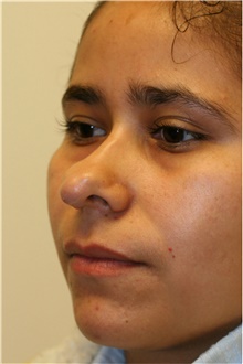 Rhinoplasty Before Photo by Steve Laverson, MD, FACS; Rancho Santa Fe, CA - Case 40054