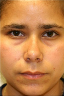 Rhinoplasty After Photo by Steve Laverson, MD, FACS; Rancho Santa Fe, CA - Case 40054