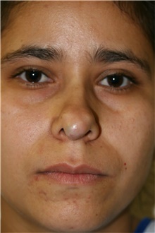 Rhinoplasty Before Photo by Steve Laverson, MD, FACS; Rancho Santa Fe, CA - Case 40054