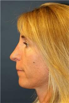 Rhinoplasty After Photo by Steve Laverson, MD, FACS; Rancho Santa Fe, CA - Case 40055