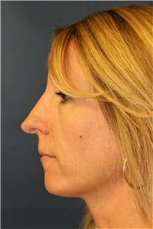 Rhinoplasty Before Photo by Steve Laverson, MD, FACS; Rancho Santa Fe, CA - Case 40055