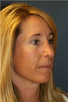 Rhinoplasty After Photo by Steve Laverson, MD, FACS; Rancho Santa Fe, CA - Case 40055