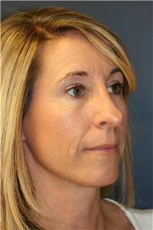 Rhinoplasty Before Photo by Steve Laverson, MD, FACS; Rancho Santa Fe, CA - Case 40055