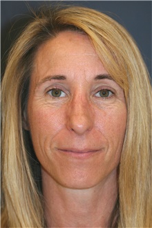 Rhinoplasty After Photo by Steve Laverson, MD, FACS; Rancho Santa Fe, CA - Case 40055