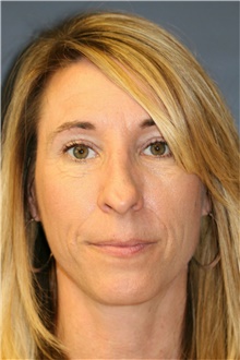 Rhinoplasty Before Photo by Steve Laverson, MD, FACS; Rancho Santa Fe, CA - Case 40055