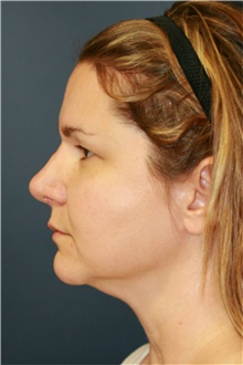 Rhinoplasty After Photo by Steve Laverson, MD, FACS; Rancho Santa Fe, CA - Case 40066