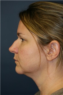 Rhinoplasty Before Photo by Steve Laverson, MD, FACS; Rancho Santa Fe, CA - Case 40066